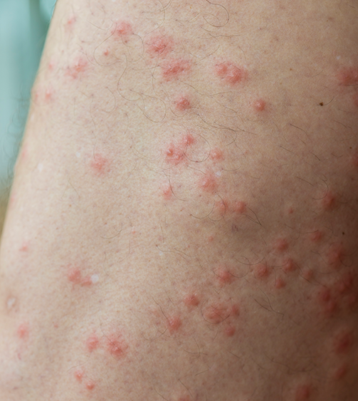 What Is a Midge How to Prevent Treat Midge Bites Insect Shield
